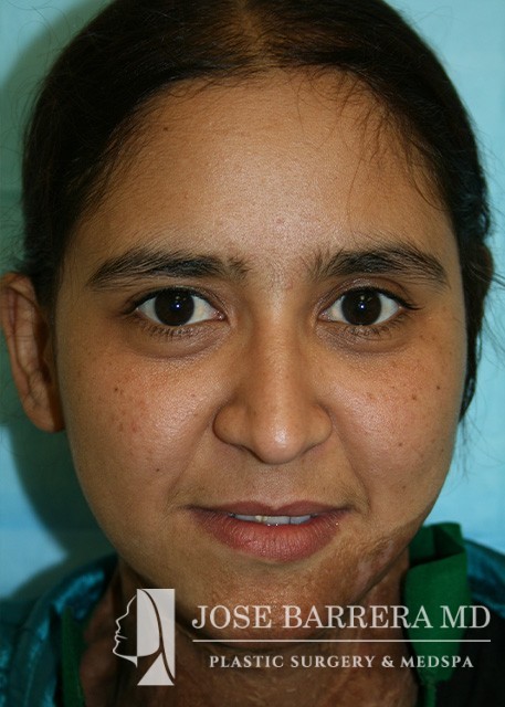 after ear reconstruction female patient