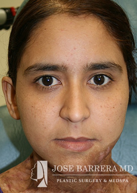 before ear reconstruction female patient