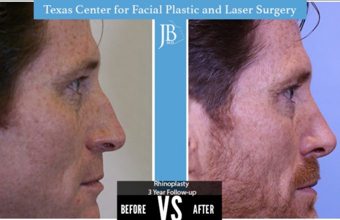 Barrera-Rhinoplasty1-Modern-Male-San-Antonio