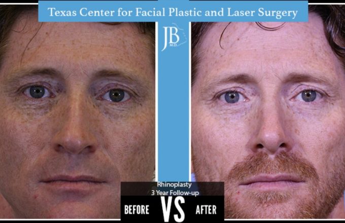 Barrera-Rhinoplasty2-Modern-Male-San-Antonio