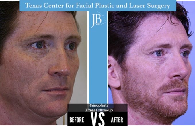 Barrera-Rhinoplasty3-Modern-Male-San-Antonio