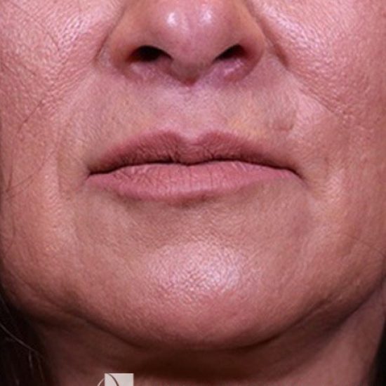 surgical-lip-lift--13784 (2)